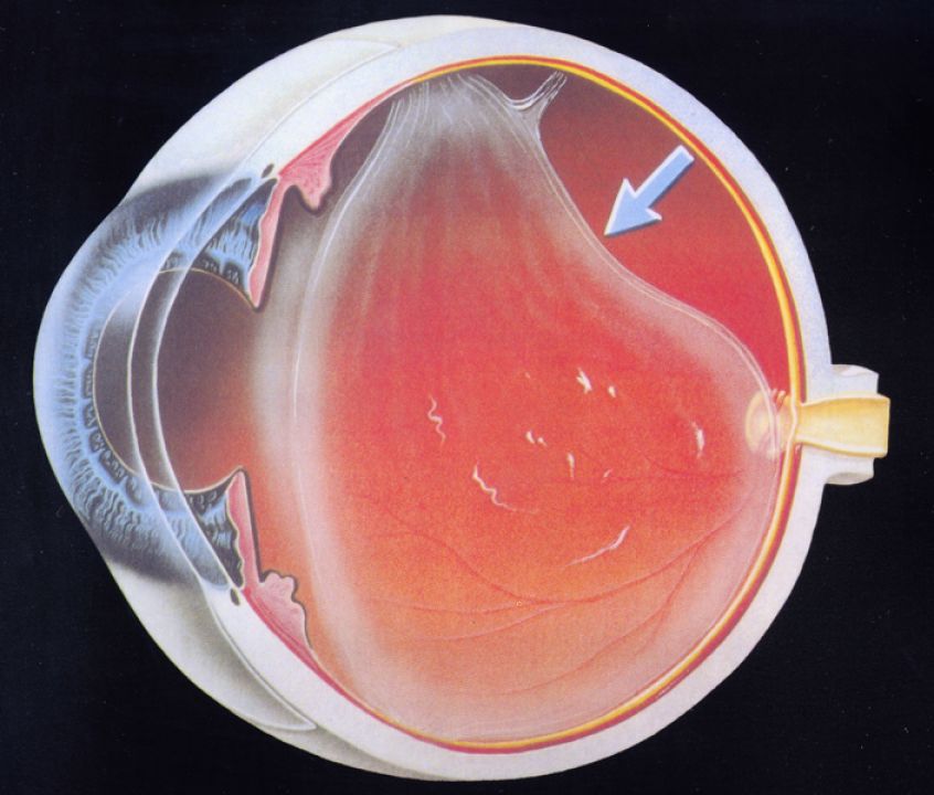 Симптомы отслоения сетчатки глаза: основные признаки и проявления
