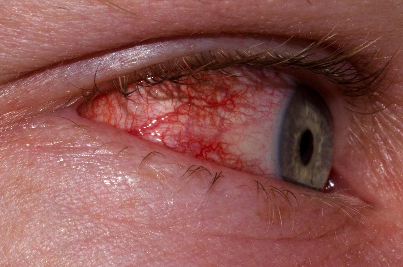 Воспаление глаз у детей - чем вызванно и как лечить