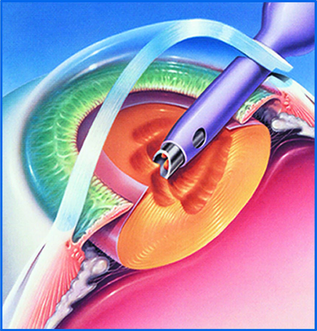 После лечения катаракты. Операция факоэмульсификация катаракты. Ультразвуковая факоэмульсификация катаракты этапы. Факоэмульсификация катаракты с имплантацией.