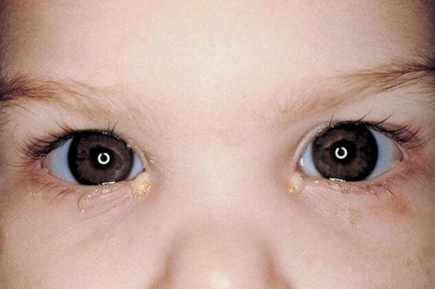 Почему гноятся глаза у новорожденного и что делать?